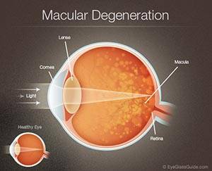 Macular Degeneration