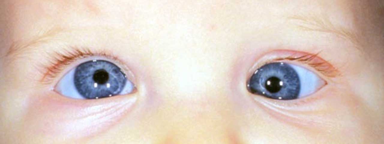 strabismus