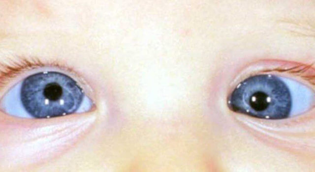 strabismus blog 1024×384