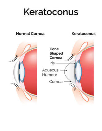 Keratocoonus Labelled