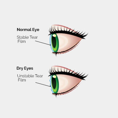 dry-eye-diagram-2a