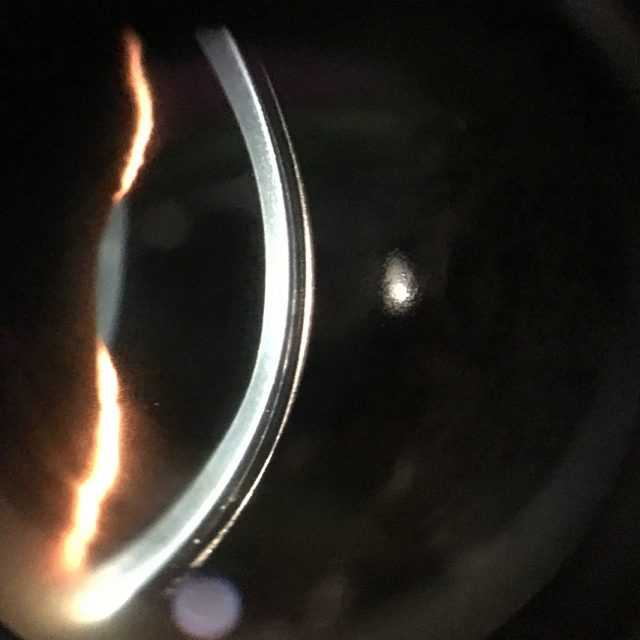 Cornea With Scleral Lens 1280×853